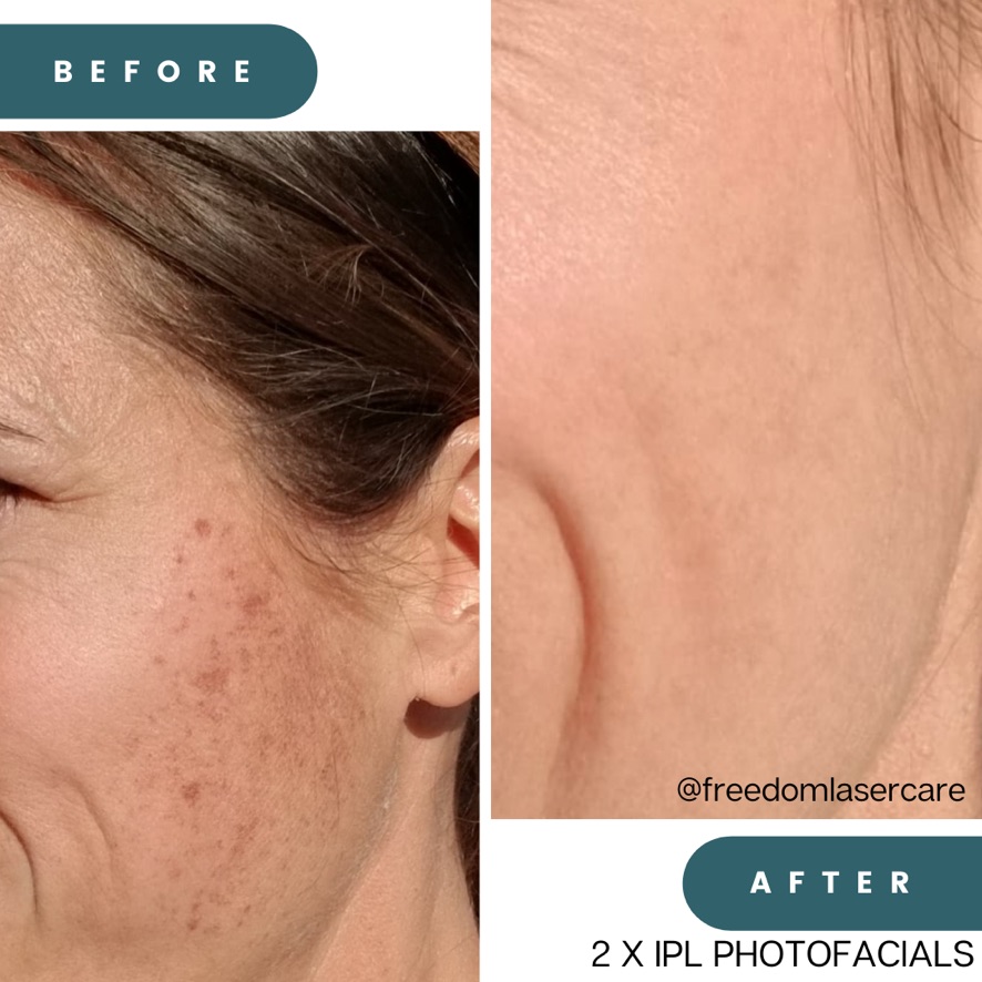 IPL Photofacial